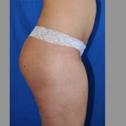 Buttock Augmentation Before & After Patient #7596