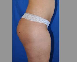 Buttock Augmentation Before & After Patient #7596