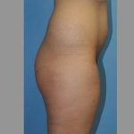 Buttock Augmentation Before & After Patient #7596