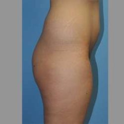 Buttock Augmentation Before & After Patient #7596