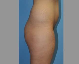 Buttock Augmentation Before & After Patient #7596