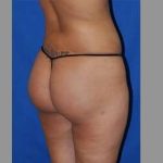 Buttock Augmentation Before & After Patient #7593