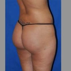 Buttock Augmentation Before & After Patient #7593