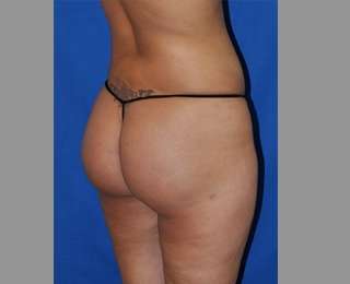 Buttock Augmentation Before & After Patient #7593