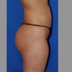 Buttock Augmentation Before & After Patient #7593