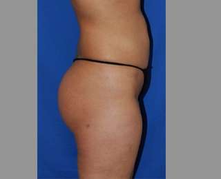 Buttock Augmentation Before & After Patient #7593
