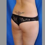 Buttock Augmentation Before & After Patient #7593