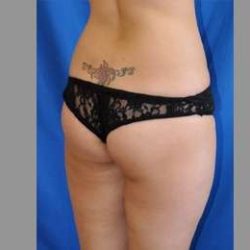 Buttock Augmentation Before & After Patient #7593