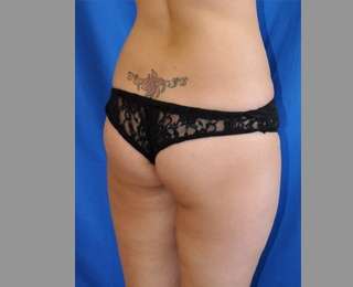 Buttock Augmentation Before & After Patient #7593