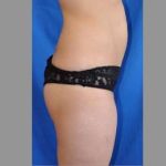 Buttock Augmentation Before & After Patient #7593