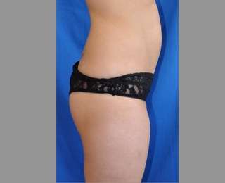 Buttock Augmentation Before & After Patient #7593