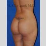 Buttock Augmentation Before & After Patient #7588