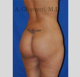 Buttock Augmentation Before & After Patient #7588