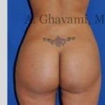 Buttock Augmentation Before & After Patient #7588