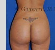 Buttock Augmentation Before & After Patient #7588