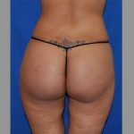 Buttock Augmentation Before & After Patient #7588