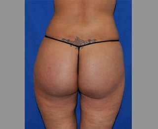 Buttock Augmentation Before & After Patient #7588