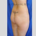 Buttock Augmentation Before & After Patient #7588