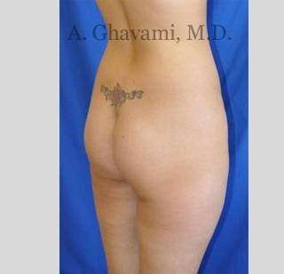 Buttock Augmentation Before & After Patient #7588