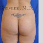 Buttock Augmentation Before & After Patient #7588