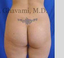 Buttock Augmentation Before & After Patient #7588
