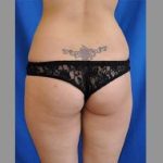 Buttock Augmentation Before & After Patient #7588