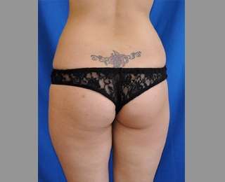 Buttock Augmentation Before & After Patient #7588