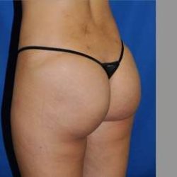 Buttock Augmentation Before & After Patient #7581
