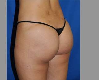 Buttock Augmentation Before & After Patient #7581