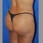 Buttock Augmentation Before & After Patient #7581