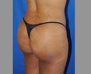 Buttock Augmentation Before & After Patient #7581