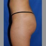 Buttock Augmentation Before & After Patient #7581