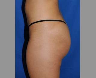 Buttock Augmentation Before & After Patient #7581