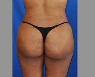 Buttock Augmentation Before & After Patient #7581