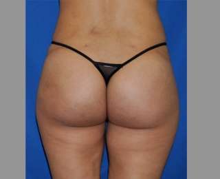 Buttock Augmentation Before & After Patient #7581