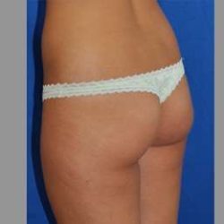 Buttock Augmentation Before & After Patient #7581