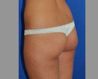 Buttock Augmentation Before & After Patient #7581