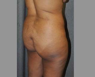 Buttock Augmentation Before & After Patient #7581
