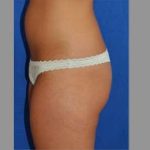 Buttock Augmentation Before & After Patient #7581
