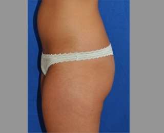Buttock Augmentation Before & After Patient #7581