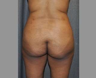 Buttock Augmentation Before & After Patient #7581