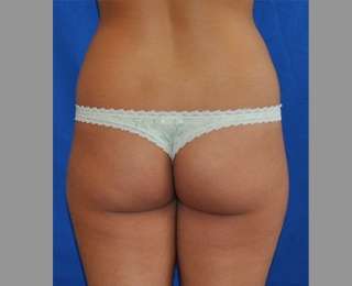 Buttock Augmentation Before & After Patient #7581