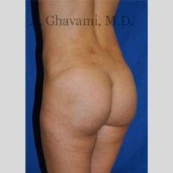 Buttock Augmentation Before & After Patient #7570