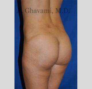 Buttock Augmentation Before & After Patient #7570