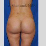 Buttock Augmentation Before & After Patient #7570