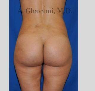 Buttock Augmentation Before & After Patient #7570