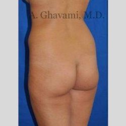 Buttock Augmentation Before & After Patient #7570