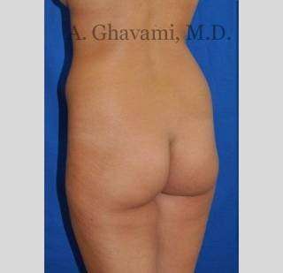 Buttock Augmentation Before & After Patient #7570
