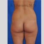Buttock Augmentation Before & After Patient #7570