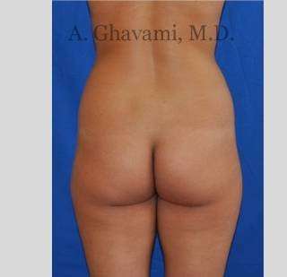 Buttock Augmentation Before & After Patient #7570